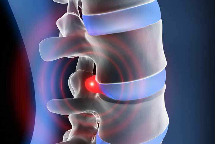 Acupuncture Can Reduce Disc Herniation Inflammation